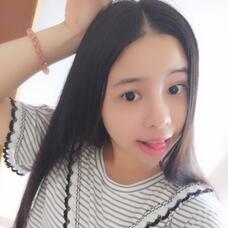 隆鼻整形真实恢复期图片 隆鼻整形一个月了