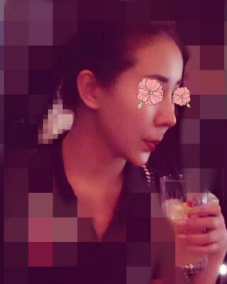 隆鼻失败修复后整给鼻形很精致，郑志敏医生做的