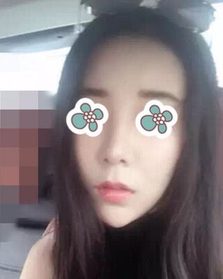 隆鼻失败修复后整给鼻形很精致，郑志敏医生做的