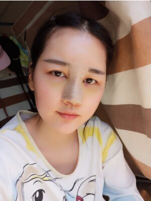 硅胶隆鼻+耳软骨垫鼻尖后美到朋友认不出