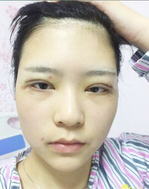全切双眼皮修复后恢复成漂亮的眼睛了