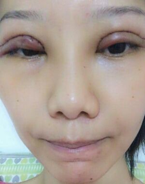 东莞美立方张克医生给我做的全切双眼皮超**