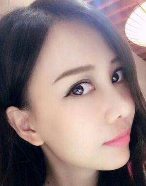 东莞美立方张克医生给我做的全切双眼皮超**