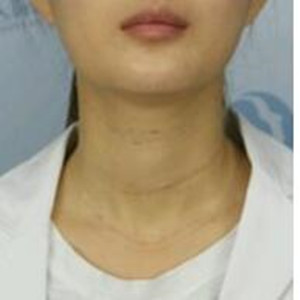 玻尿酸注射去颈纹果真的很明X哦 大家可以去试试