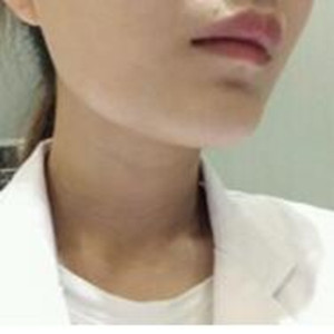 玻尿酸注射去颈纹果真的很明X哦 大家可以去试试