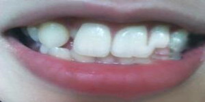 做了美容冠矫正 现在我的牙齿整齐又漂亮