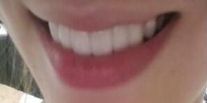 做了美容冠矫正 现在我的牙齿整齐又漂亮