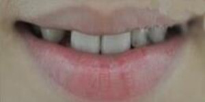 做了美容冠矫正 现在我的牙齿整齐又漂亮