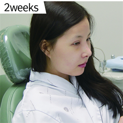 曹仁昌做的双眼皮，分享下恢复前后对比果照片哦~