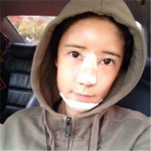 分享面部自体脂肪填充前后的照片，还有恢复过程，果很好哦~