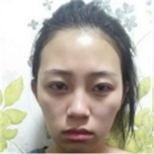 自体脂肪面部填充一年了，分享我的恢复过程，有前后对比照片哦~