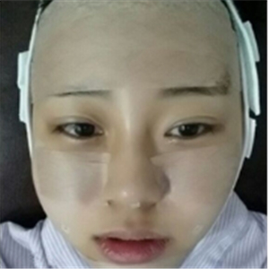 自体脂肪面部填充一年了，分享我的恢复过程，有前后对比照片哦~