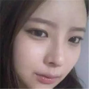 做了磨颧骨和面部脂肪填充，分享前后对比果图片哦~