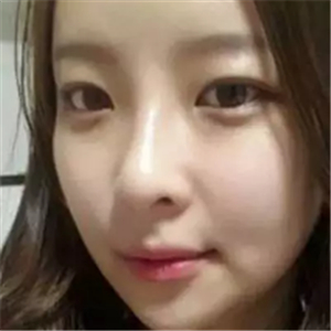 做了磨颧骨和面部脂肪填充，分享前后对比果图片哦~