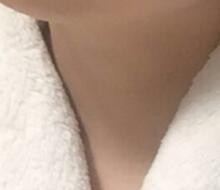 电波l皮除皱去颈纹价格19800元——紧肤果挺好的