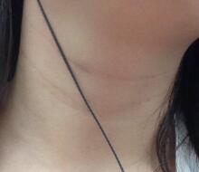 电波l皮除皱去颈纹价格19800元——紧肤果挺好的