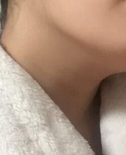 电波l皮除皱是刺激胶原蛋白的增生