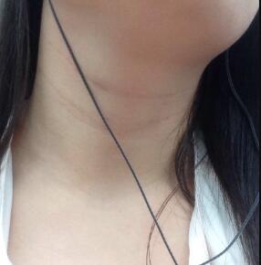 电波l皮除皱去颈纹恢复4天了