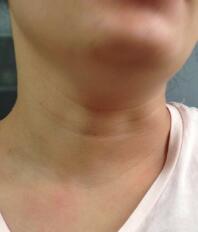 电波l皮除皱紧肤