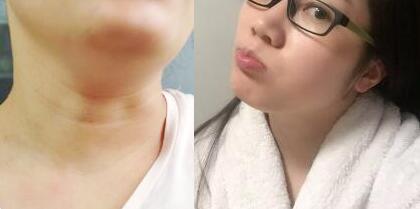 电波l皮除皱去颈纹前后对比图