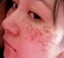 激光去雀斑价格3800元，术后恢复过程和术后注意事项分享