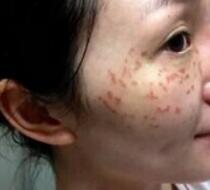 激光去雀斑价格3800元，术后恢复过程和术后注意事项分享