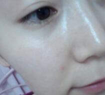 激光去雀斑价格3800元，术后恢复过程和术后注意事项分享