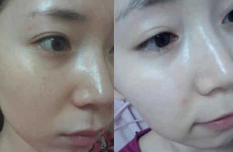 激光去雀斑手术前后对比照