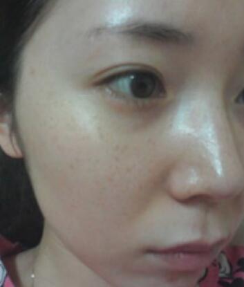 激光去雀斑手术前的照片