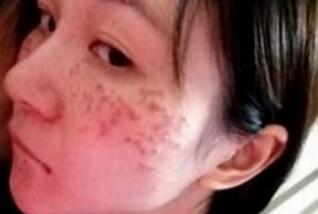 激光去雀斑手术后的照片