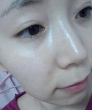 激光去雀斑手术后照片