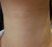 高强度聚焦超声去颈纹美容，真实整形过程和价格分享