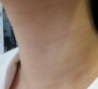 高强度聚焦超声去颈纹美容，真实整形过程和价格分享