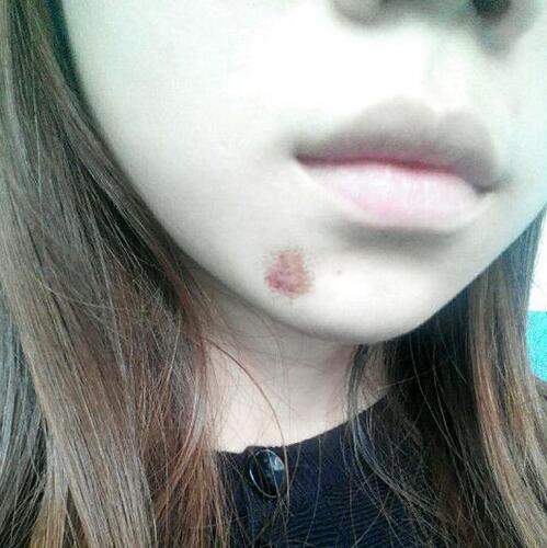 在厦门*菲做的激光祛疤过程分享