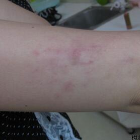 激光祛红色胎记和跟随了我20多年的胎记终于说拜拜了