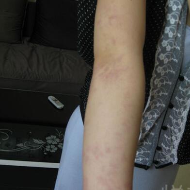 激光祛红色胎记和跟随了我20多年的胎记终于说拜拜了