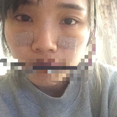 自体脂肪填充泪沟手术前后对比照片和恢复过程分享