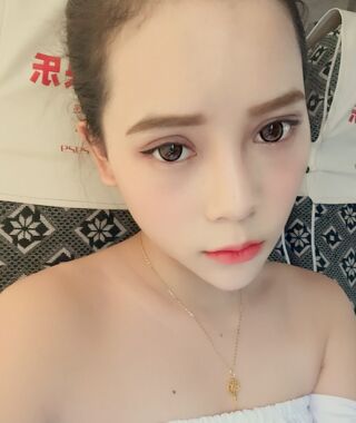 尹度龙医生做的双眼皮无比的自然美丽