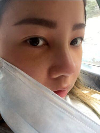 做了隆鼻整形手术果真的很不错 大家快来看看吧