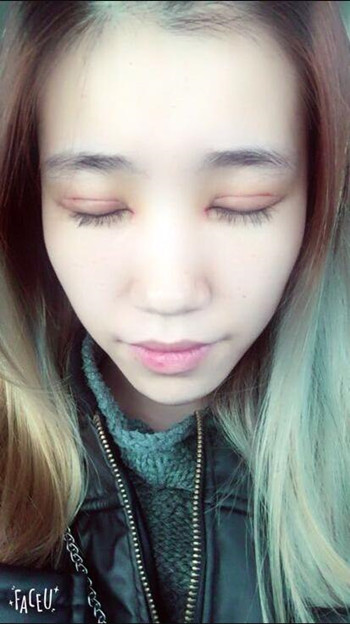 做了全切双眼皮 整个眼睛都变大了气质也不一样了