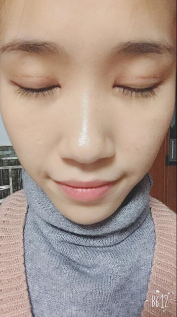 做了全切双眼皮 整个眼睛都变大了气质也不一样了