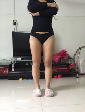 大腿吸脂手术真的是解决很难减下去的良药 看我得果就知道