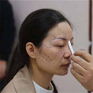 鼻部综合整形+自体脂肪丰苹果肌前后对比果图片分享哦~