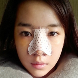 广州博仕做了隆鼻整形半年了，分享恢复过程和前后对比果照片哦~