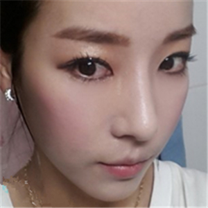 广州博仕做了隆鼻整形半年了，分享恢复过程和前后对比果照片哦~