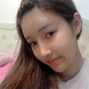 去年做了隆鼻整形，分享恢复过程和前后对比果图片哦，