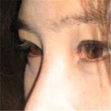 分享我的双眼皮+开内眼角+切除鼻中隔软骨整形手术恢复经历~