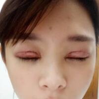 割双眼皮开眼角价格12000元，眼部整形对比照片和恢复过程分享