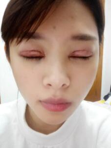 双眼皮+开眼角手术恢复过程图