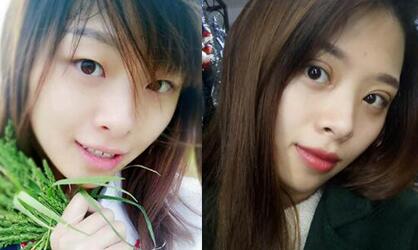 恢复过程中的割双眼皮开眼角手术前后对比图